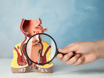 Fissure Treatment Without Surgery in Ghaziabad